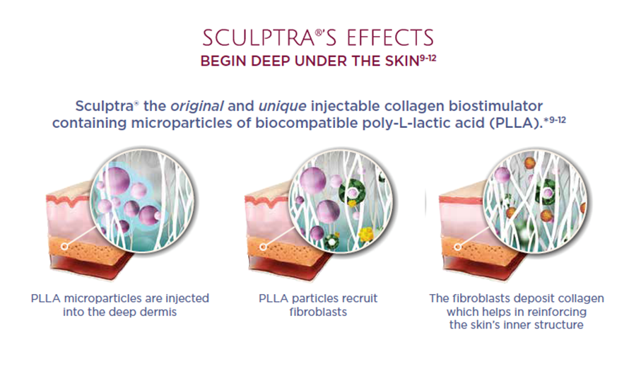 Sculptra behandling illustration